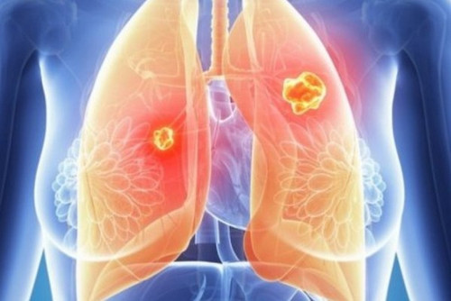 Рак легких: три необычных признака на лице